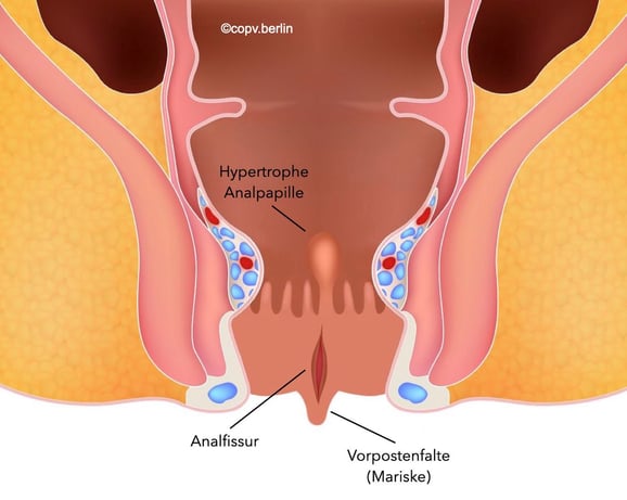 Erscheinungen bei der chronischen Analfissur - Proktologie Berlin