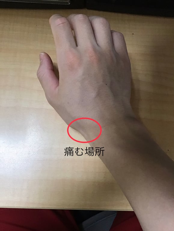 女性 手の痛み