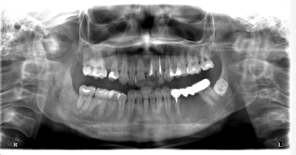 Через 2 місяці після операції