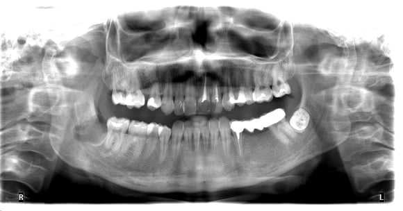 ОПГ після операції