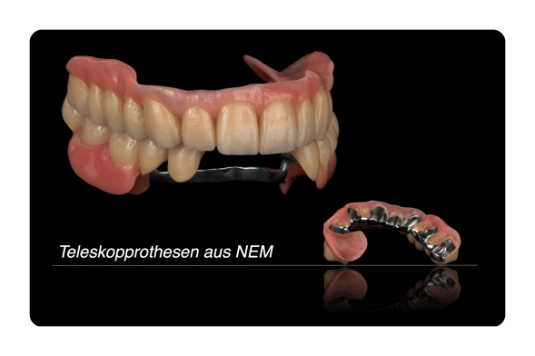 Teleskopprothesen, Teleskopprothese NEM, herausnehmbarer Zahnersatz.