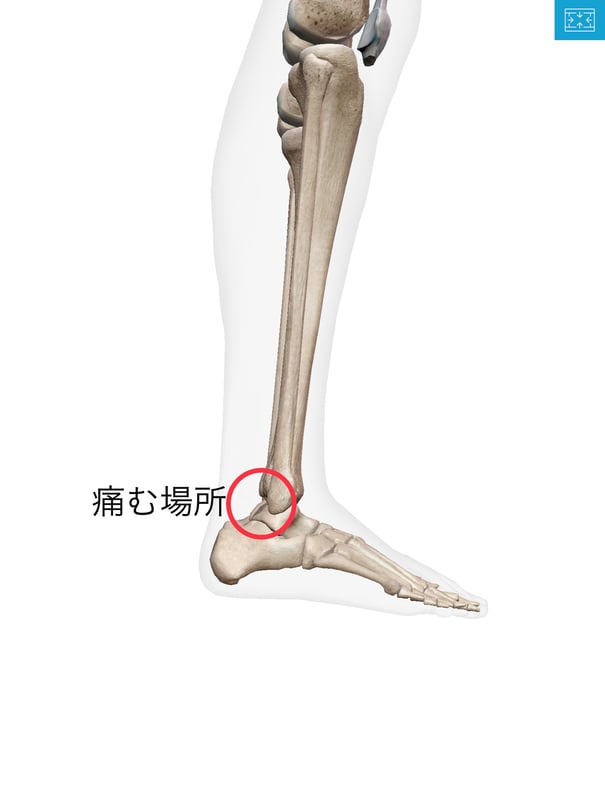 三角骨障害 バレーの痛み