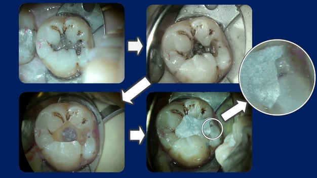 アマルガム充填のステップ