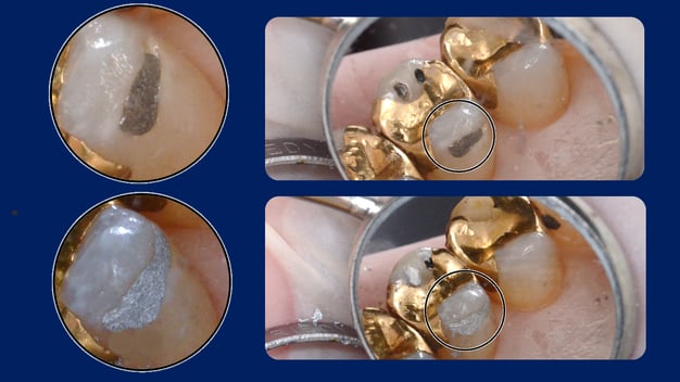 欠けたアマルガムを修復し直し