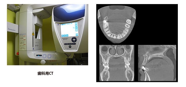 歯科用CT