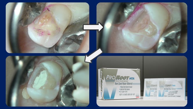 MTAの神経保存確率な98%