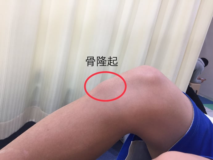 オスグット病 膝の痛み