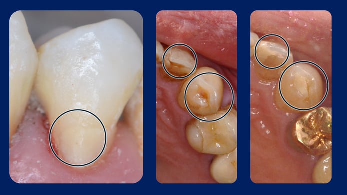 歯の根元に詰められたRIVA