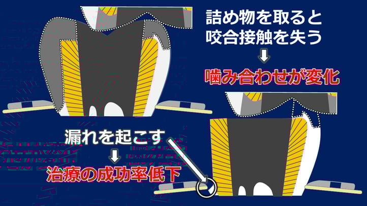 米国では修復物は外さず治療が行われます。修復物を外すと、感染のリスクと咬合の崩壊のリスクを増加させることになります。