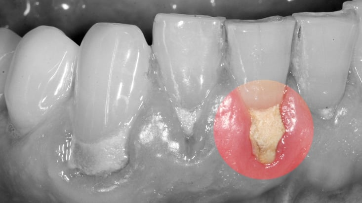 Tartre supra-gingival