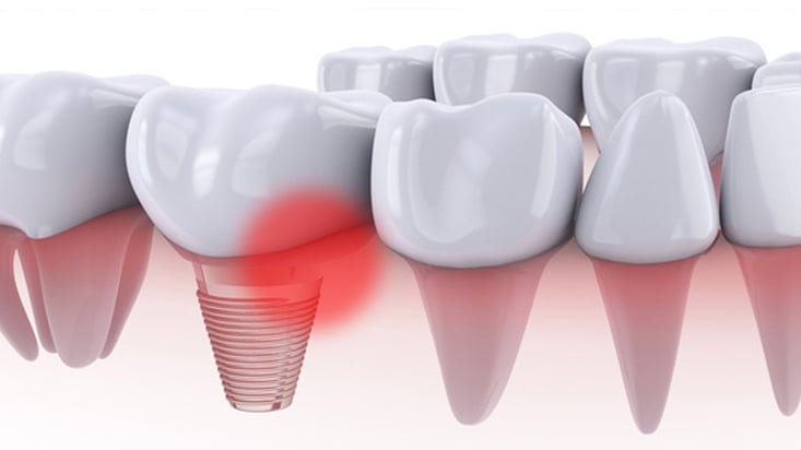 ParoSphère | La mucosite péri-implantaire. Crédit photo : © rommma