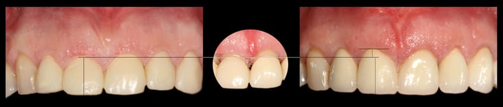 Elongation coronaire - ParoSphère