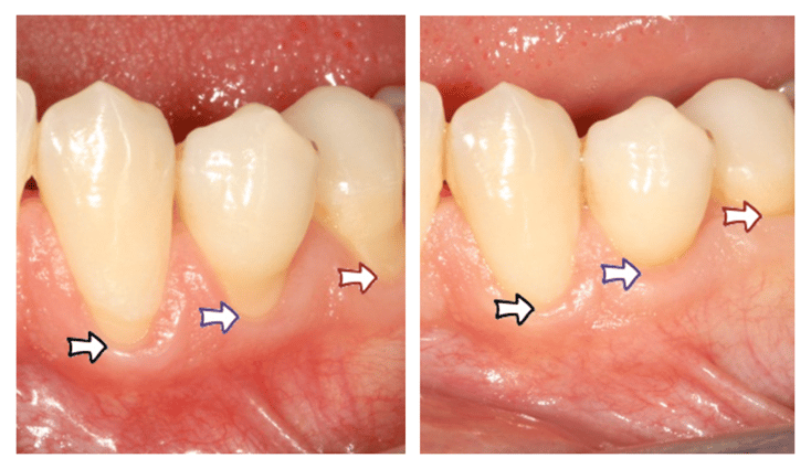 Recouvrement de la racine dénudée avec une greffe de conjonctif enfoui © ParoSphère