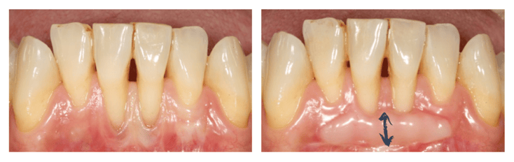 Greffe épithélio-conjonctive en regard de récessions gingivales © ParoSphère