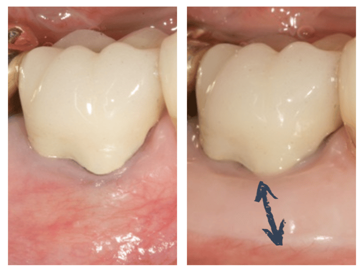 Greffe épithélio-conjonctive en regard d'une couronne dentaire prothétique © ParoSphère