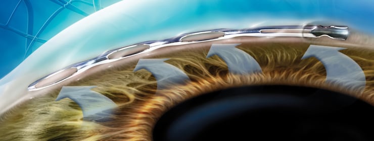 Hydrus Stent, rechts das Inlet, links die drei kleinen Öffnungen, die im Schlemmschen Kanal liegen