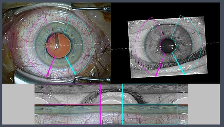 Links oben ist das Livebild aus dem Mikroskop zu erkennen. Oben rechts das bei der Voruntersuchung aufgenommene Bild. Unten werden die in lila und hellblau markierten "aufgeklappten" Anteile der Bindehaut automatisch abgeglichen. 