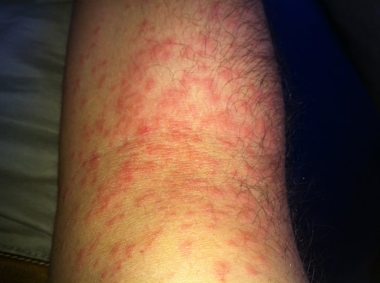 Urticaire provoqué par les poils de la chenille processionnaire du pin