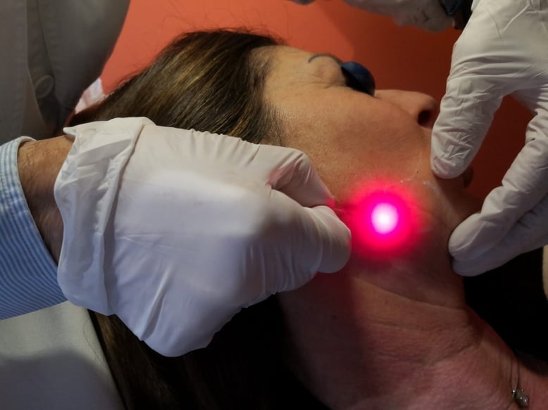 Endolaserlift 1470 Nm: ringiovanimento linea mandibolare