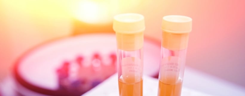 Platelet rich plasma for pilonidal cyst