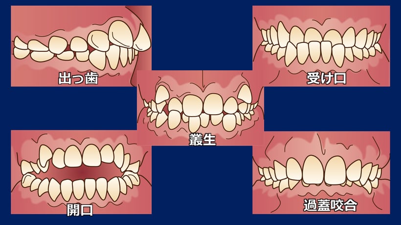 歯並びが悪いと、顎ズレを起こしている可能性はかなり高いといえます。