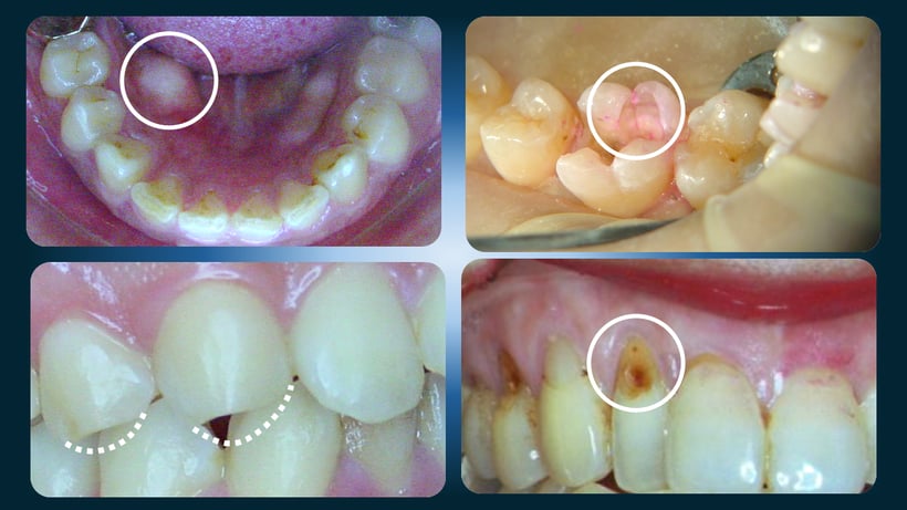 顎関節症で現れる歯の症状、歯のヒビ、下顎骨隆起、切端の咬耗、WSD(楔状欠損）