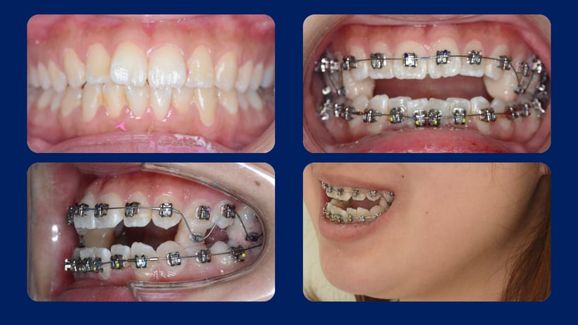 バイトアップ法で奥歯を引き出します。