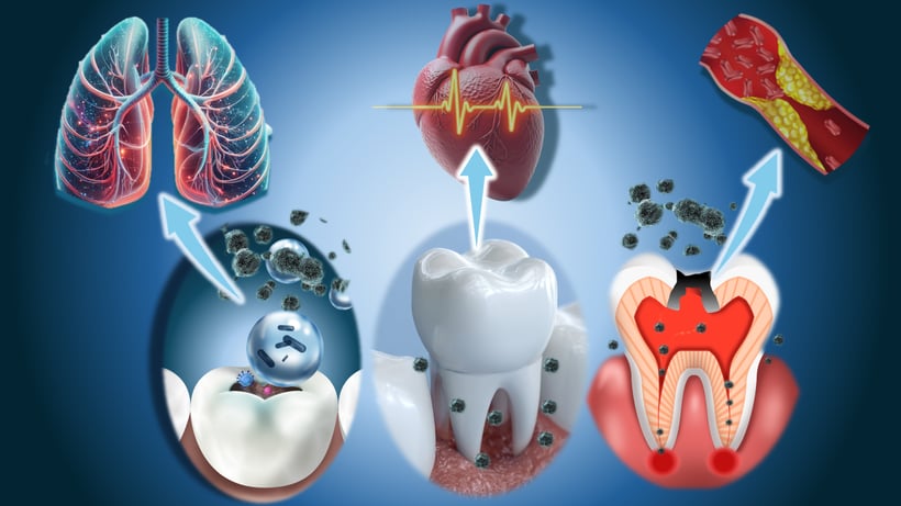 歯の細菌感染によって、心臓疾患、動脈硬化、認知症が起こる
