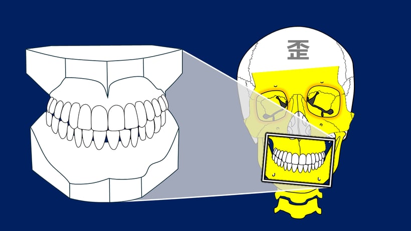 左右的な3次元的歪は並行模型では診断できない。
