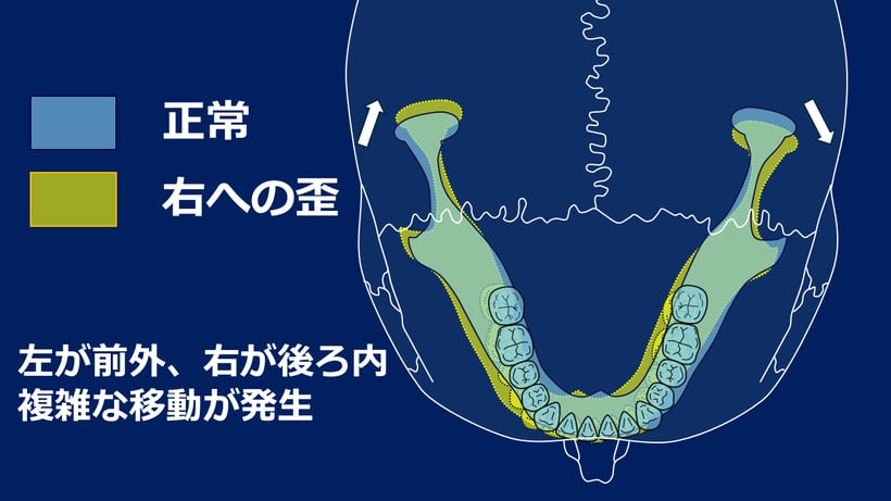 歪んだ側の顎関節が奥に入り、関節周囲の筋肉の緊張を強める