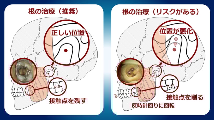 歯の接触点を削って根管治療をすると顎関節症になる場合があります。