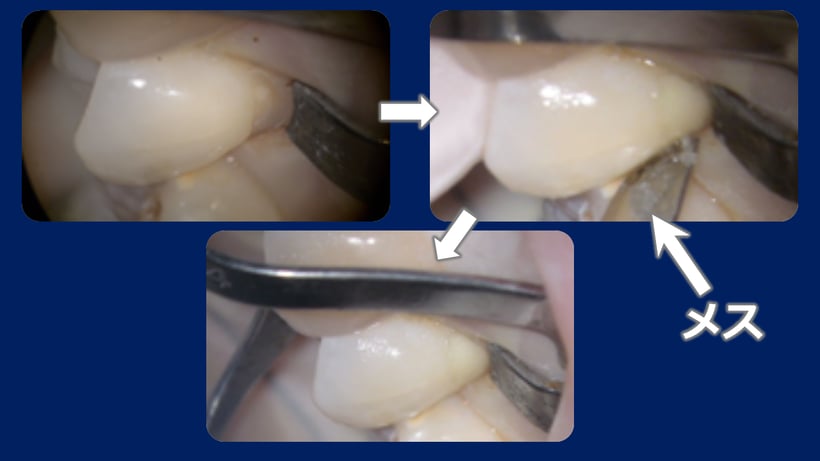 WDSの治療、WSD専用のクランプを使い、RIVAを充填、メスで仕上げます。