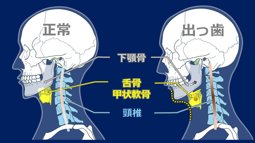 顎がズレることでリバースネックに、舌骨、甲状軟骨のが前下方に移動、喉元が膨らむ
