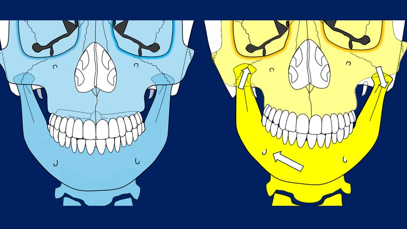 顎が左右に歪むとき、ゆがんだ側の顎関節が上奥に入る