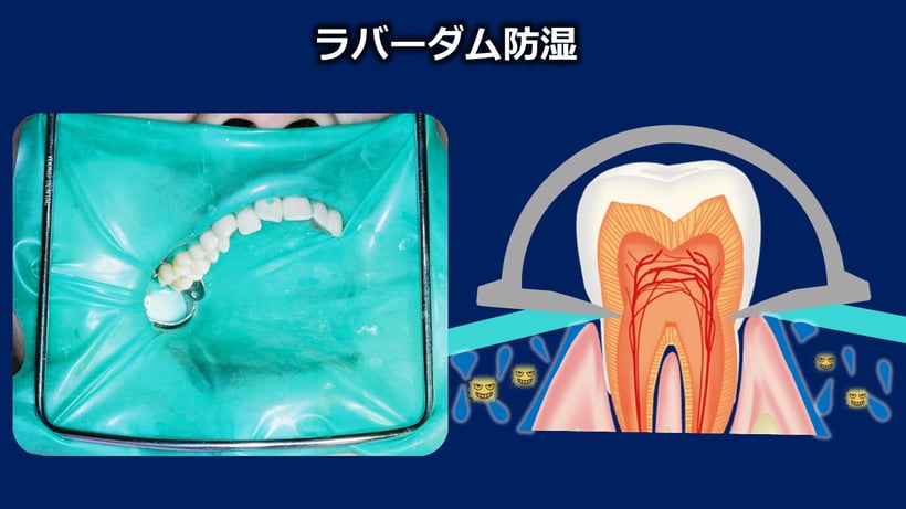 ラバーダムが治療中に水分や細菌が治療部位に侵入しないようにしていることを示した図。