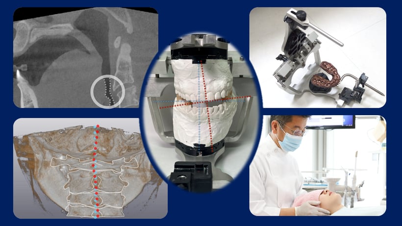 CT撮影と咬合器マウント