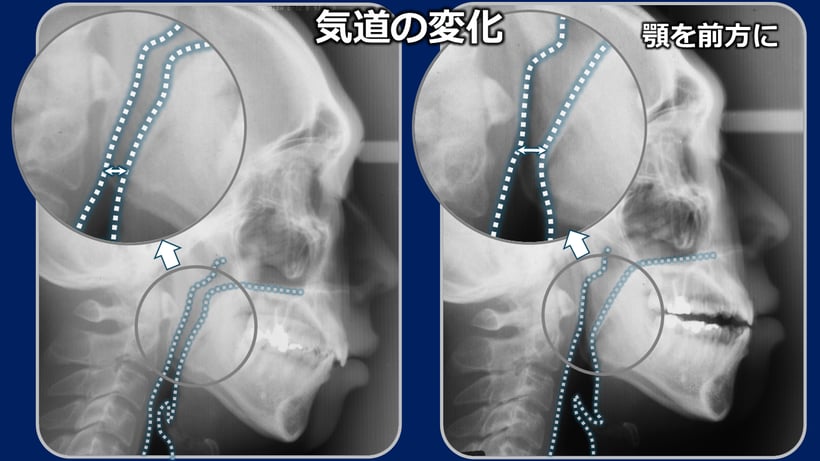 左は普段噛んでいるときのセファロレントゲン写真、右は顎を前に出した状態で撮影したもの、気道の広さが違っているのが分かる