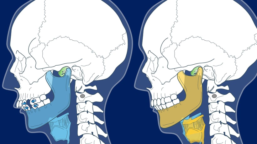 抜歯をすると前歯と臼歯がともに引き合う