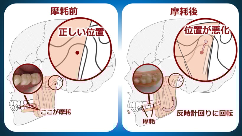奥歯の入れ歯では、手入れを怠ると歯が摩耗したり、土手が減るなどして噛み合わせが狂い、顎がズレてきます。