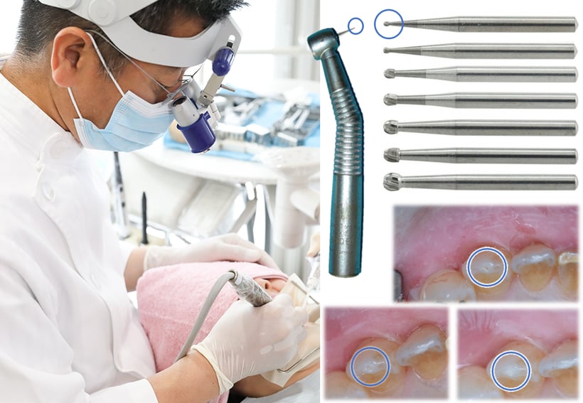 極小のバーで歯を削り詰める