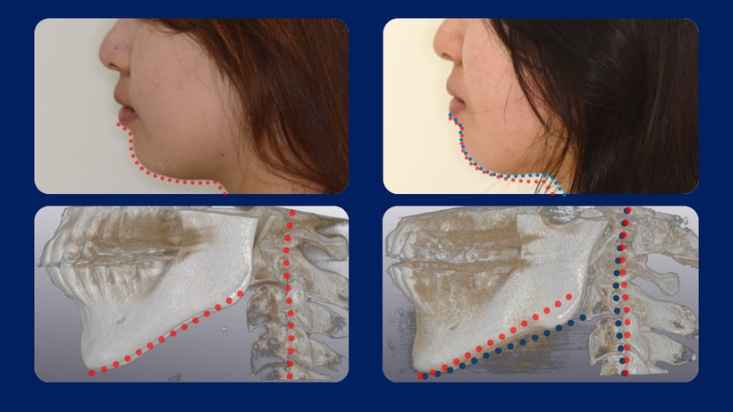 CTで顎の角度が変化しているのが分かります。
