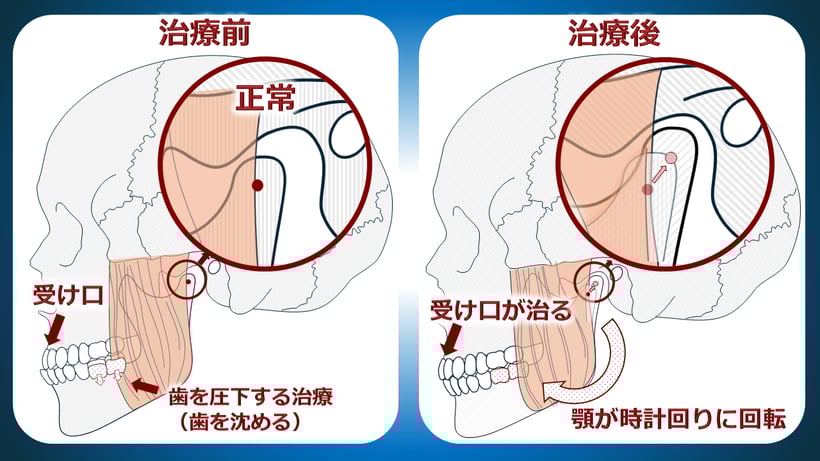 矯正治療で顎がズレ、全身の歪の原因になったケース