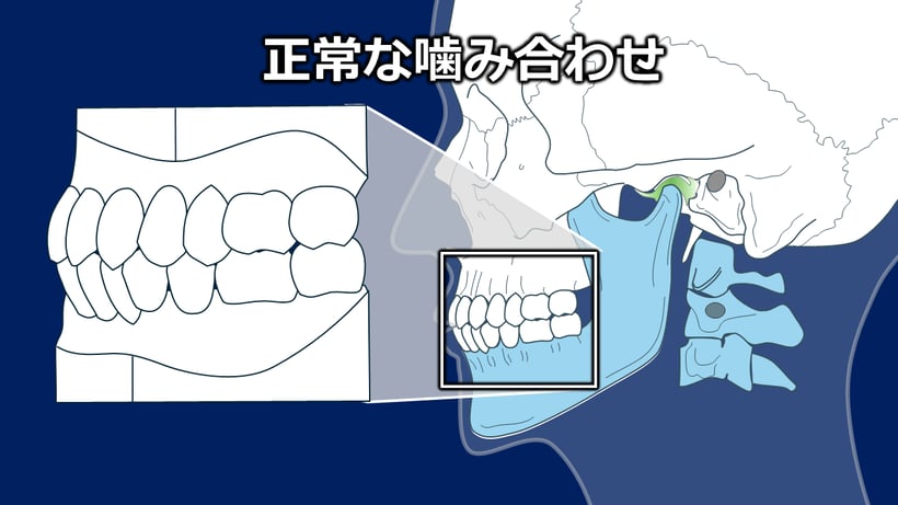 正常な咬合平面では問題がない。