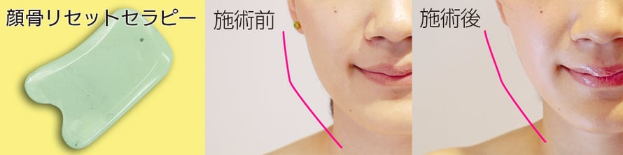 顔骨リセットセラピーによる施術例（かっさプレートはイメージです）