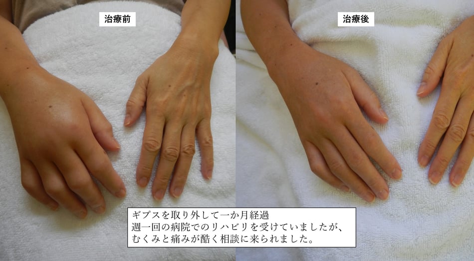 長期固定による浮腫　関節拘縮