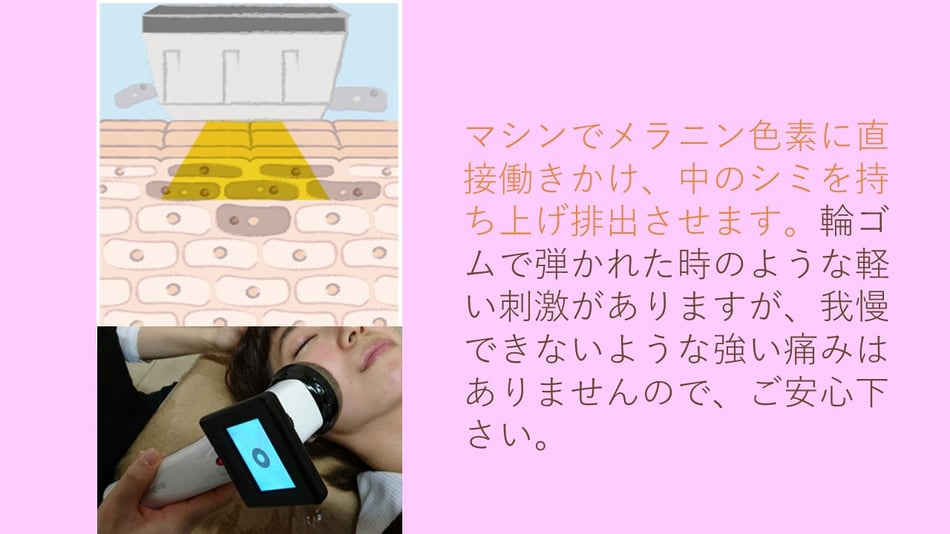 マイクロスコープでメラニン色素に直接働きかけ、中のシミを持ち上げ排出させます。輪ゴムで弾かれた時のような軽い刺激がありますが、我慢できないような強い痛みはありませんので、ご安心ください。