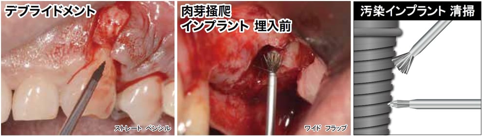 デブライドメント、肉芽掻爬 インプラント 埋入前。汚染インプラント 清掃